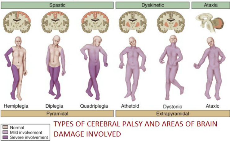 Symptoms And Diagnosis Of Cerebral Palsy Cerebral - vrogue.co